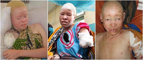Albinos são cruelmente mutilados